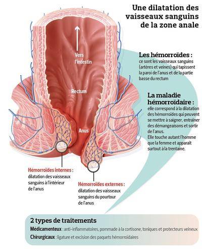 Que peut-on faire contre les hémorroïdes douloureuses ? Ces méthodes ont fonctionné